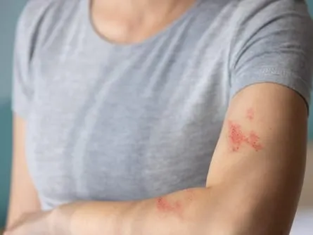 Stock photograph of a model: a woman in a gray T-shirt shows a red shingles rash on her upper arm