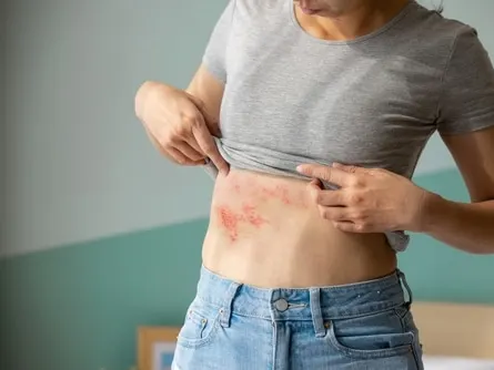 Stock photograph of a model: a woman lifts her gray T-shirt to show a red shingles rash on her side