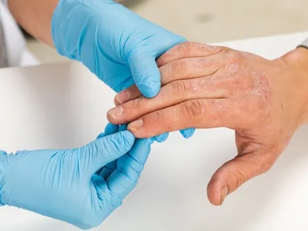 Stock photograph of models: a clinician in blue gloves examines a patient’s hand, which has rough, scaly patches
