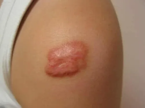 A raised, red keloid scar on a person’s upper arm