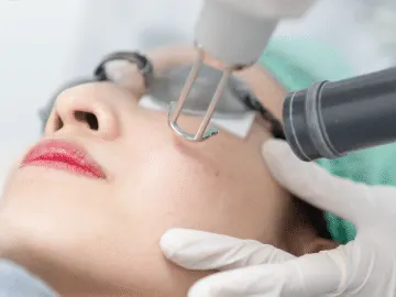 Stock photograph of models: a gloved clinician holds a laser handpiece to the cheek of a woman who lies back wearing eye shields