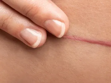 Stock photograph of a model: fingers stretch the skin either side of a thin raised scar