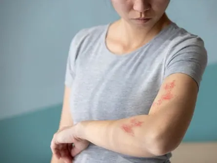 Stock photograph of a model: a woman in a gray T-shirt looks down at a red shingles rash on her forearm