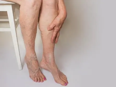 Stock photograph of a model: an older woman sits on a stool with a hand on her calf, visible veins showing on her legs