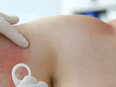 Stock photograph of a model: a gloved clinician’s hands examining a person’s upper arm that shows reddened skin, with a small round tool in view.