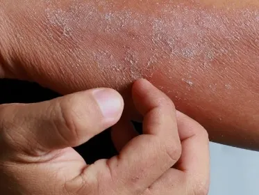 Stock photograph of a model: a forearm and elbow with dry, flaking skin, pinched gently between the fingers of the other hand.
