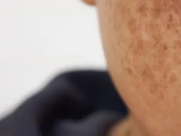 Stock photograph of a model: close crop of a woman’s cheek and lips with brown patches of discoloured skin on the cheek.