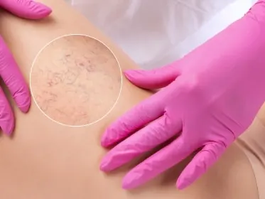 Stock photograph of a model: pink-gloved hands rest on a woman’s thigh, with a circled magnified inset showing fine red and blue veins under the skin.