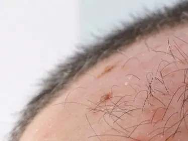 Stock photograph of a model: close view of a man’s closely cropped scalp and forehead with scattered rough, crusted red-brown spots and stray hairs.