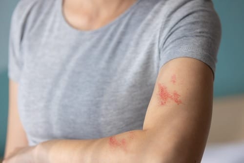 Stock photograph of a model: a woman in a gray T-shirt shows a red shingles rash on her upper arm