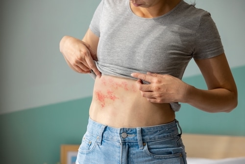 Stock photograph of a model: a woman lifts her gray T-shirt to show a red shingles rash on her side