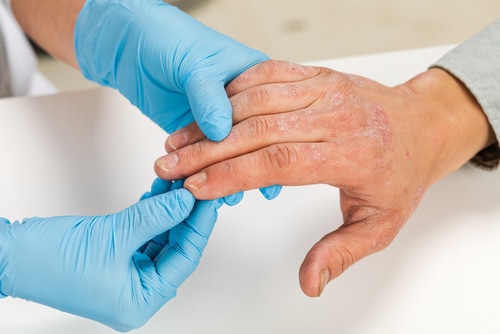 Stock photograph of models: a clinician in blue gloves examines a patient’s hand, which has rough, scaly patches