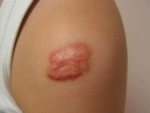 A raised, red keloid scar on a person’s upper arm