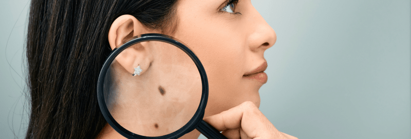 Stock photograph of a model: a magnifying glass over a mole on a woman’s cheek