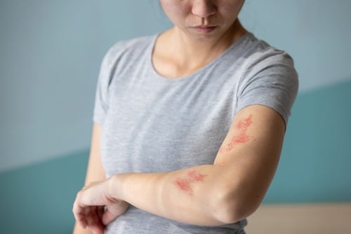 Stock photograph of a model: a woman in a gray T-shirt looks down at a red shingles rash on her forearm