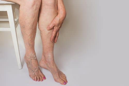 Stock photograph of a model: an older woman sits on a stool with a hand on her calf, visible veins showing on her legs