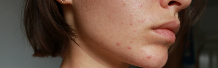 Stock photograph of a model: side view of a woman’s cheek and jaw with a few small red blemishes, short brown hair framing her face.