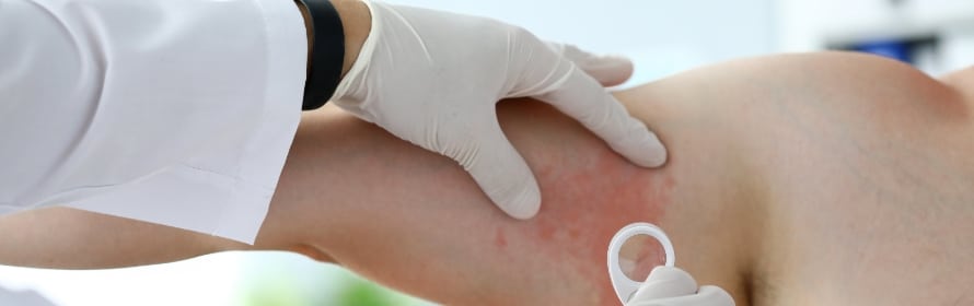 Stock photograph of a model: a gloved clinician’s hands examining a person’s upper arm that shows reddened skin, with a small round tool in view.