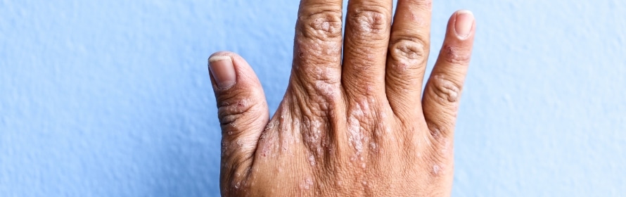 Stock photograph of a model: the back of a hand held against a blue wall, its skin rough and spotted with small raised patches.