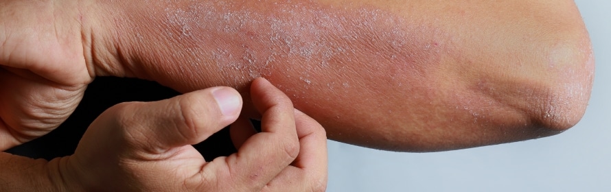 Stock photograph of a model: a forearm and elbow with dry, flaking skin, pinched gently between the fingers of the other hand.