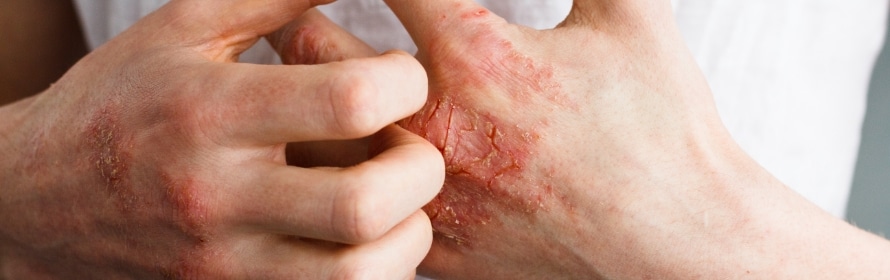Stock photograph of a model: two hands with red, cracked, scaly skin on the back of one hand, the fingers scratching the area.