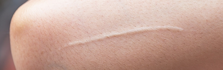 Stock photograph of a model: close view of a long, thin, raised pale scar running diagonally across a person’s arm.