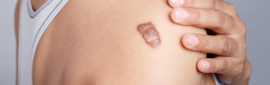 Stock photograph of a model: a person in a grey tank top with a raised, dark purple-brown scar on the upper side, one hand on the shoulder.
