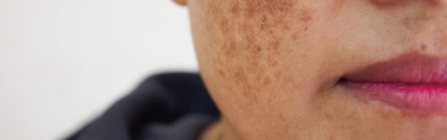 Stock photograph of a model: close crop of a woman’s cheek and lips with brown patches of discoloured skin on the cheek.