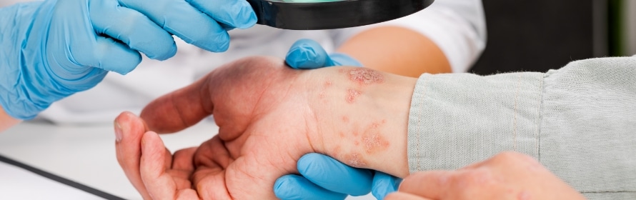 Stock photograph of a model: gloved hands hold a magnifying glass over a person’s wrist and hand that show scaly pink patches.