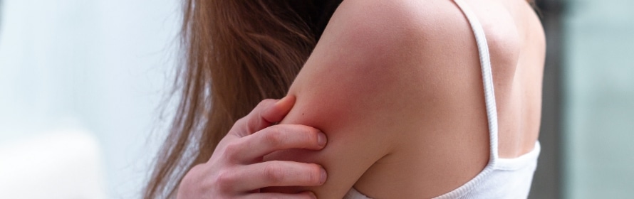 Stock photograph of a model: a woman in a white camisole with long brown hair touching her upper arm, where the skin looks red.
