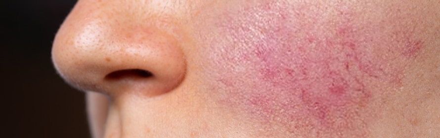 Stock photograph of a model: close side view of a person’s nose and cheek with pink-red flushing and fine visible blood vessels on the cheek.