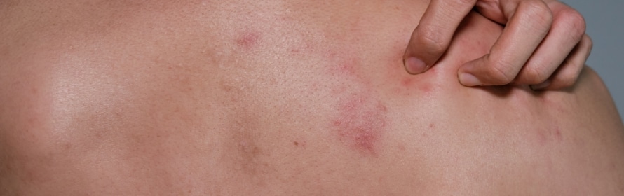 Stock photograph of a model: a person’s bare back with a streak of pink-red spots, one hand scratching near the shoulder.