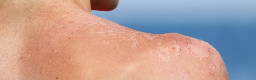 Stock photograph of a model: a person’s reddened, peeling shoulder and upper back against a blue sky.