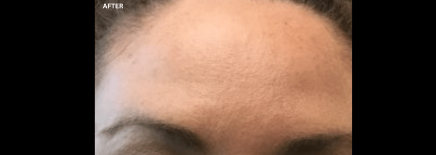 After treatment: the same view of the forehead with the skin between the brows looking smoother, labelled “AFTER”.