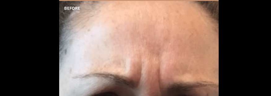 Before treatment: a view of a forehead from above the brows, with vertical lines between the brows, labelled “BEFORE”.