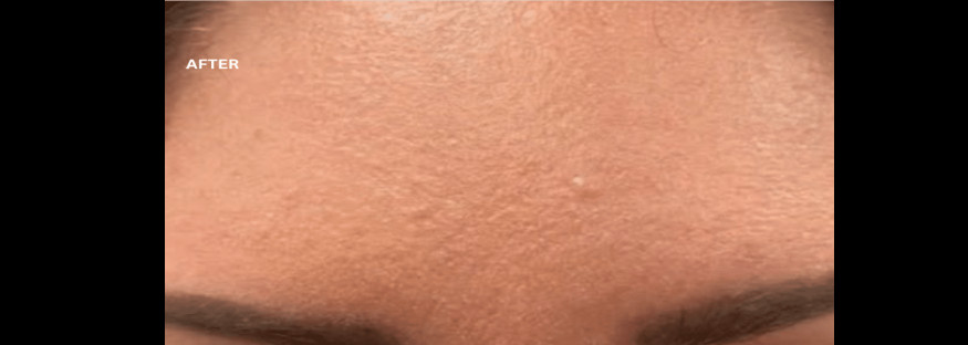 After treatment: the same view of the forehead with smooth skin between the brows, labelled “AFTER”.