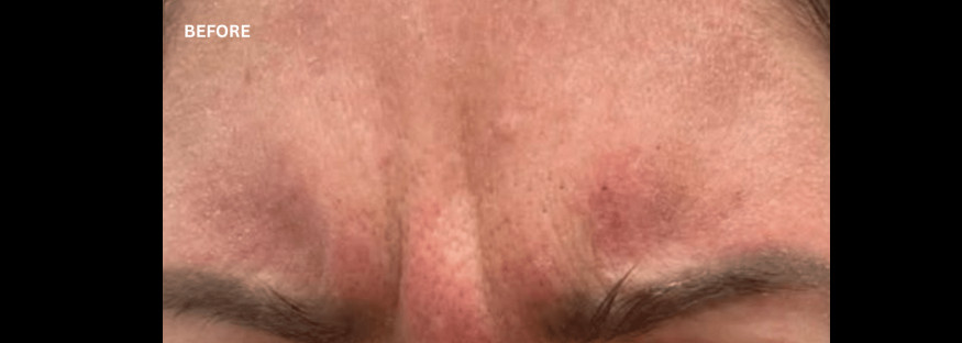Before treatment: a close view of a forehead and the tops of the brows, with creases and redness between the brows, labelled “BEFORE”.