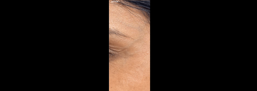 After treatment: the same narrow side view of the outer eye corner, the lines beside the eye less pronounced, labelled “AFTER”.