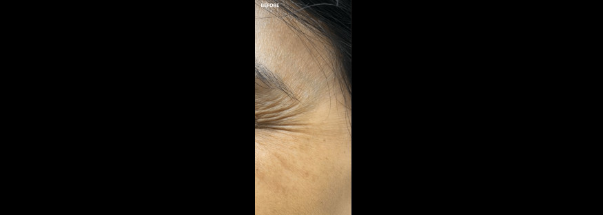 Before treatment: a narrow side view of the outer corner of an eye, with fine lines radiating from the eye towards the temple, labelled “BEFORE”.