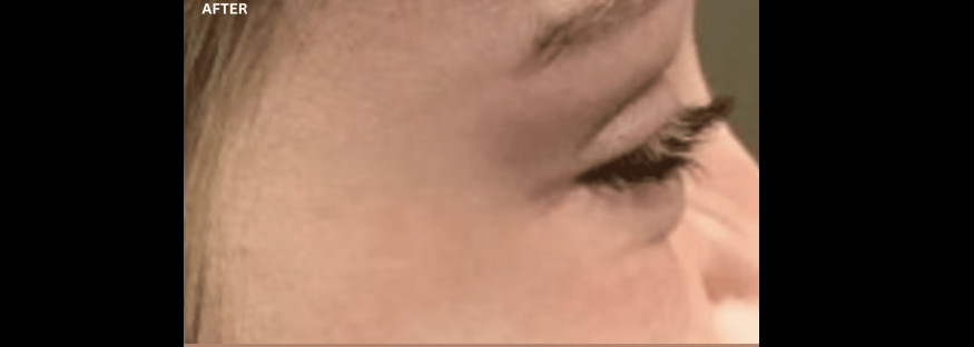 After treatment: the same side view of the eye corner with the skin beside the eye looking smoother, labelled “AFTER”.
