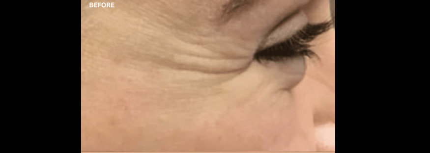 Before treatment: a side view of the corner of an eye, with fine lines fanning out from the eye towards the temple, labelled “BEFORE”.