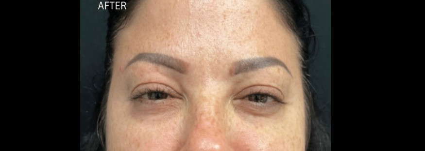After treatment: the same view of the woman’s face with the brows relaxed and the skin between them smoother, labelled “AFTER”.