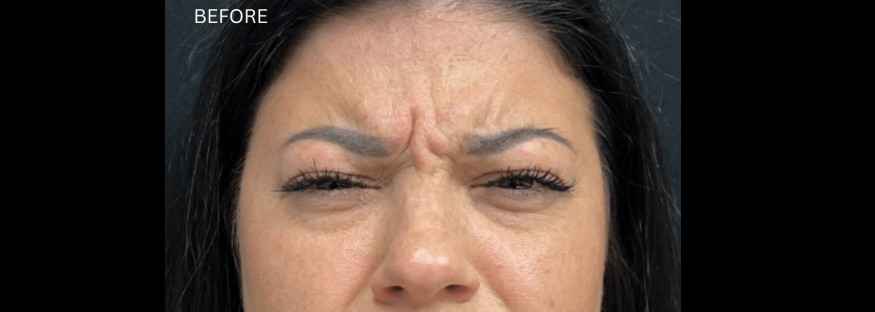 Before treatment: a close view of a woman’s face from the hairline to the nose, brows drawn together with deep vertical frown lines between them, labelled “BEFORE”.